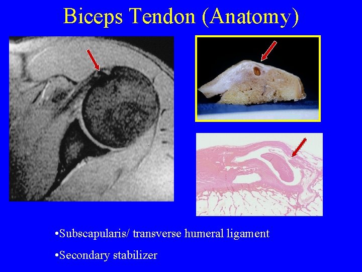 Biceps Tendon (Anatomy) • Subscapularis/ transverse humeral ligament • Secondary stabilizer 