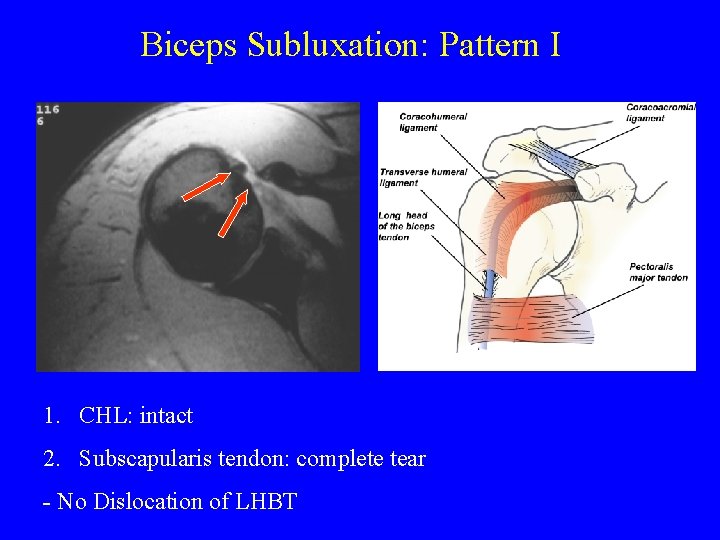 Biceps Subluxation: Pattern I 1. CHL: intact 2. Subscapularis tendon: complete tear - No