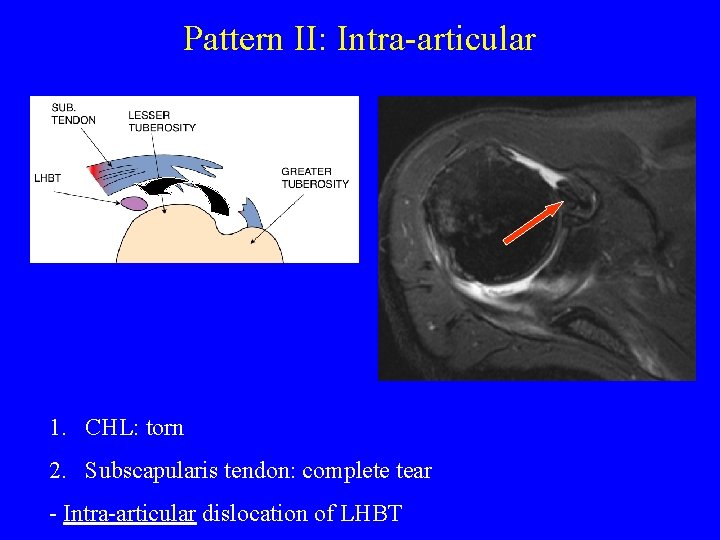 Pattern II: Intra-articular 1. CHL: torn 2. Subscapularis tendon: complete tear - Intra-articular dislocation