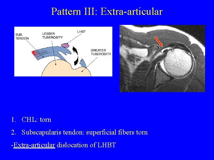 Pattern III: Extra-articular 1. CHL: torn 2. Subscapularis tendon: superficial fibers torn -Extra-articular dislocation