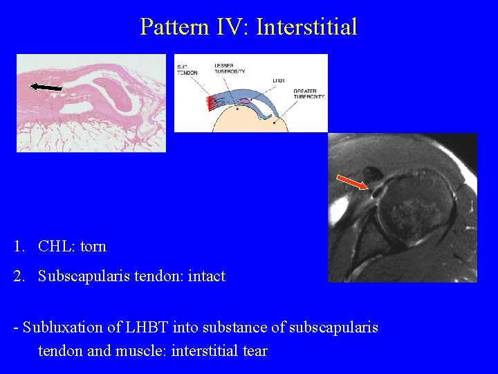 Pattern IV: Interstitial 1. CHL: torn 2. Subscapularis tendon: intact - Subluxation of LHBT