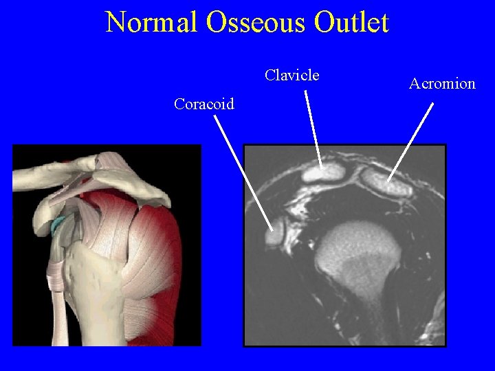 Normal Osseous Outlet Clavicle Coracoid Acromion 