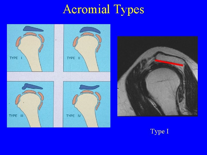 Acromial Types Type I 