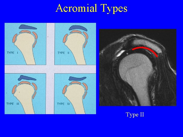 Acromial Types Type II 