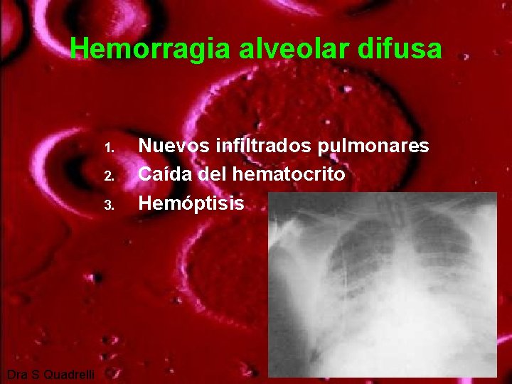 Hemorragia alveolar difusa 1. 2. 3. Dra S Quadrelli Nuevos infiltrados pulmonares Caída del