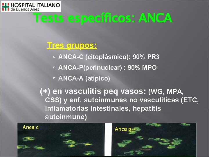 Tests específicos: ANCA Tres grupos: ANCA-C (citoplásmico): 90% PR 3 ANCA-P(perinuclear) : 90% MPO