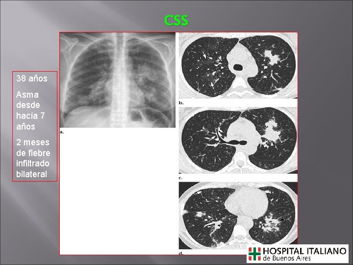 CSS 38 años Asma desde hacía 7 años 2 meses de fiebre infiltrado bilateral