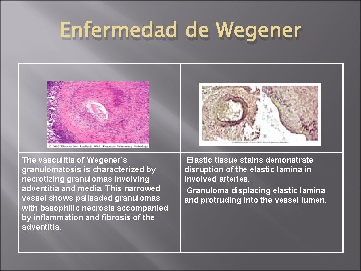Enfermedad de Wegener The vasculitis of Wegener’s granulomatosis is characterized by necrotizing granulomas involving