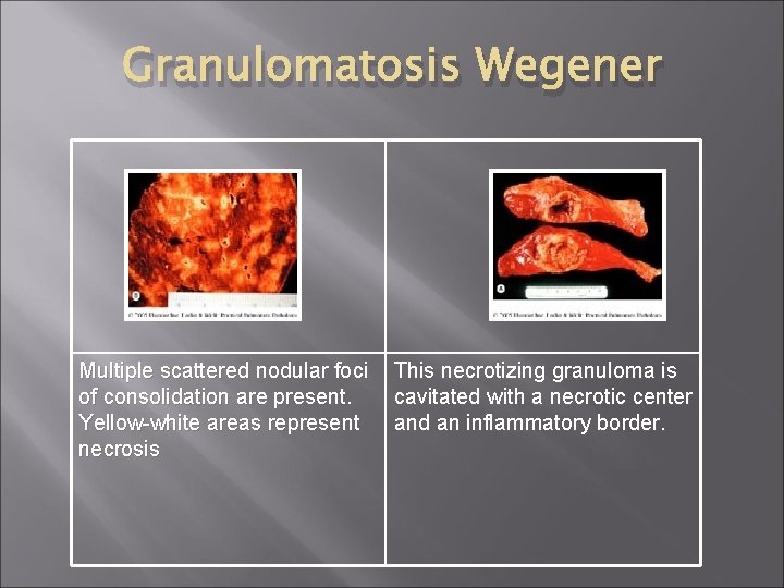 Granulomatosis Wegener Multiple scattered nodular foci of consolidation are present. Yellow-white areas represent necrosis