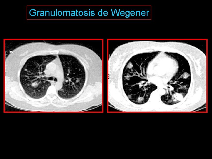 Granulomatosis de Wegener 