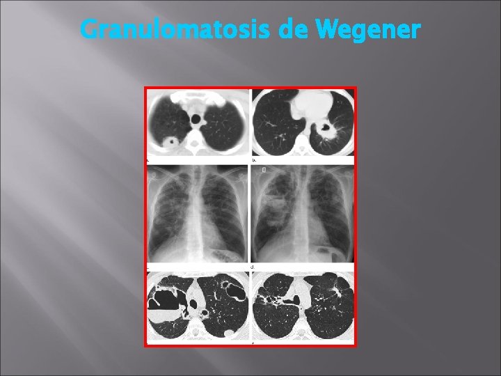 Granulomatosis de Wegener 