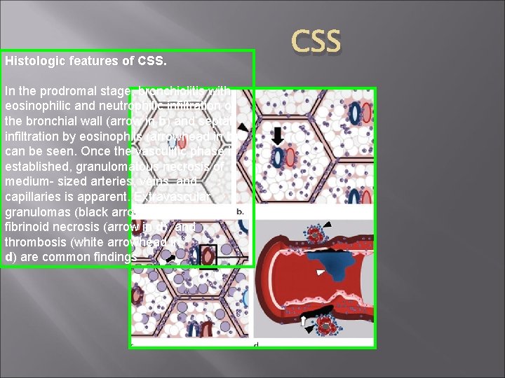 Histologic features of CSS. In the prodromal stage, bronchiolitis with eosinophilic and neutrophilic infiltration