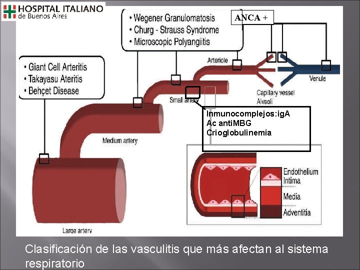 ANCA + Inmunocomplejos: ig. A Ac anti. MBG Crioglobulinemia Clasificación de las vasculitis que