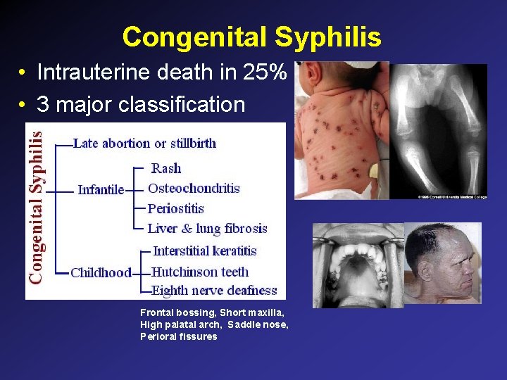 Congenital Syphilis • Intrauterine death in 25% • 3 major classification Frontal bossing, Short Congenital Syphilis • Intrauterine death in 25% • 3 major classification Frontal bossing, Short