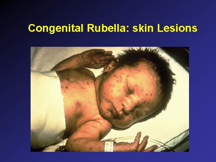 Congenital Rubella: skin Lesions Congenital Rubella: skin Lesions