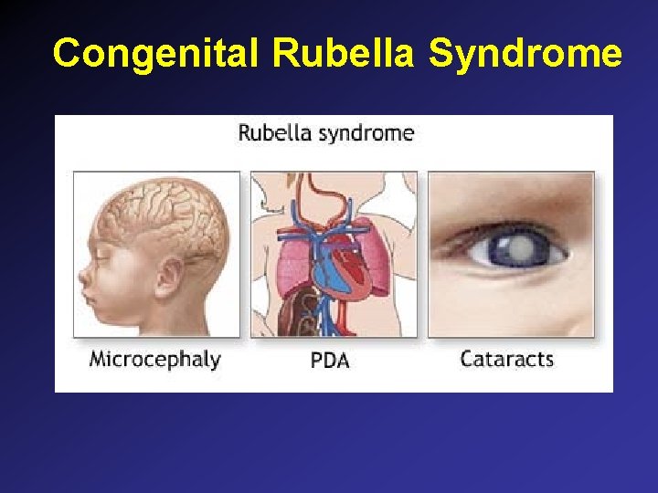Congenital Rubella Syndrome Congenital Rubella Syndrome