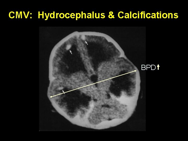 CMV: Hydrocephalus & Calcifications BPD CMV: Hydrocephalus & Calcifications BPD