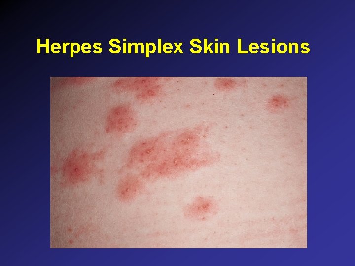 Herpes Simplex Skin Lesions Herpes Simplex Skin Lesions