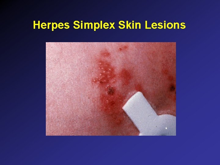Herpes Simplex Skin Lesions Herpes Simplex Skin Lesions