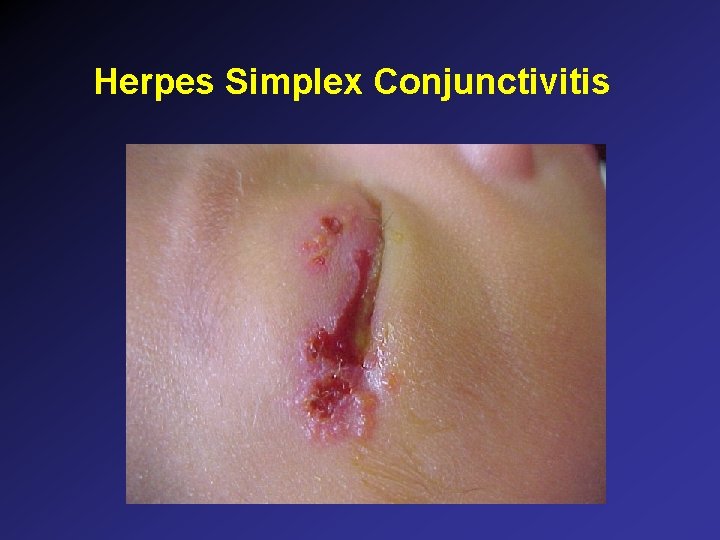 Herpes Simplex Conjunctivitis Herpes Simplex Conjunctivitis