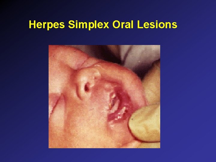 Herpes Simplex Oral Lesions Herpes Simplex Oral Lesions