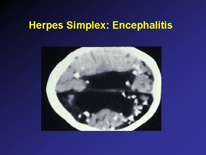 Herpes Simplex: Encephalitis Herpes Simplex: Encephalitis