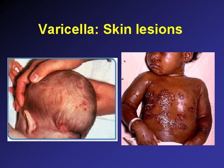 Varicella: Skin lesions Varicella: Skin lesions