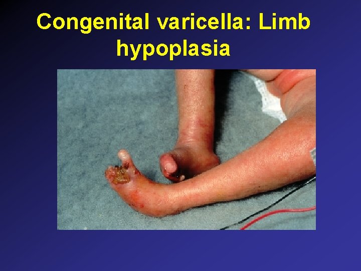 Congenital varicella: Limb hypoplasia Congenital varicella: Limb hypoplasia