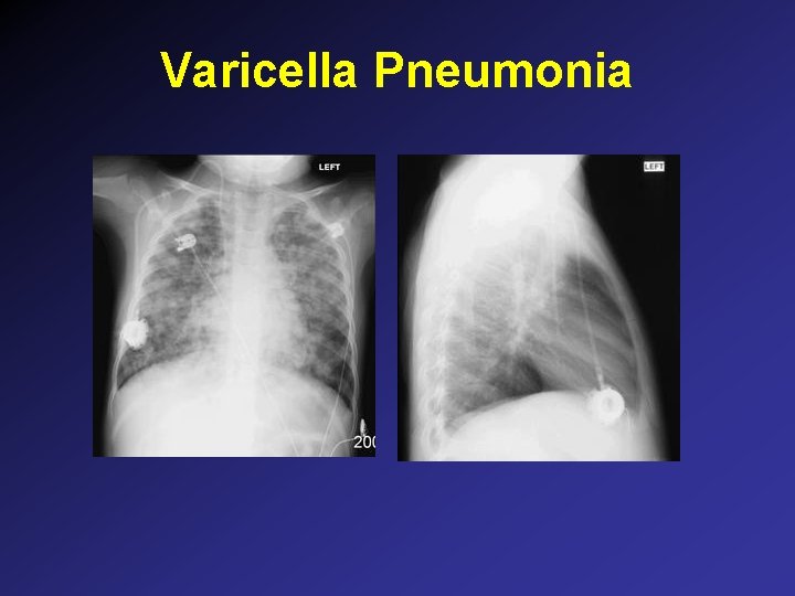 Varicella Pneumonia Varicella Pneumonia