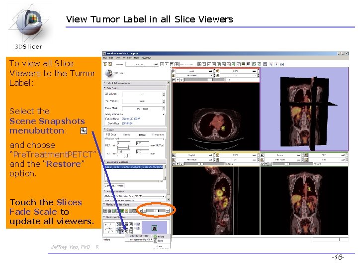 View Tumor Label in all Slice Viewers To view all Slice Viewers to the