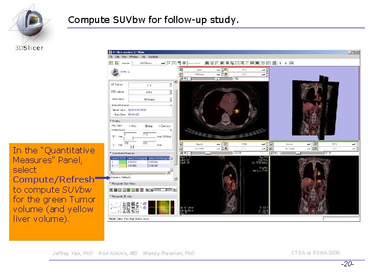 Compute SUVbw for follow-up study. In the “Quantitative Measures” Panel, select Compute/Refresh to compute