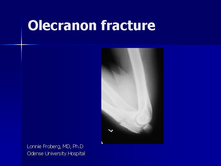 Olecranon fracture Lonnie Froberg, MD, Ph. D Odense University Hospital 