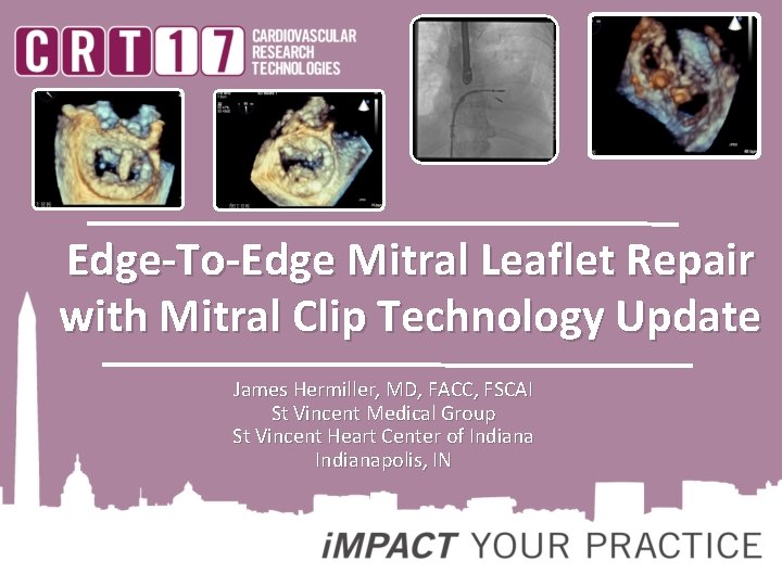 Edge-To-Edge Mitral Leaflet Repair with Mitral Clip Technology Update James Hermiller, MD, FACC, FSCAI