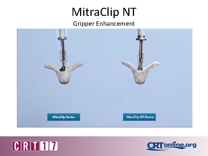 Mitra. Clip NT Gripper Enhancement 