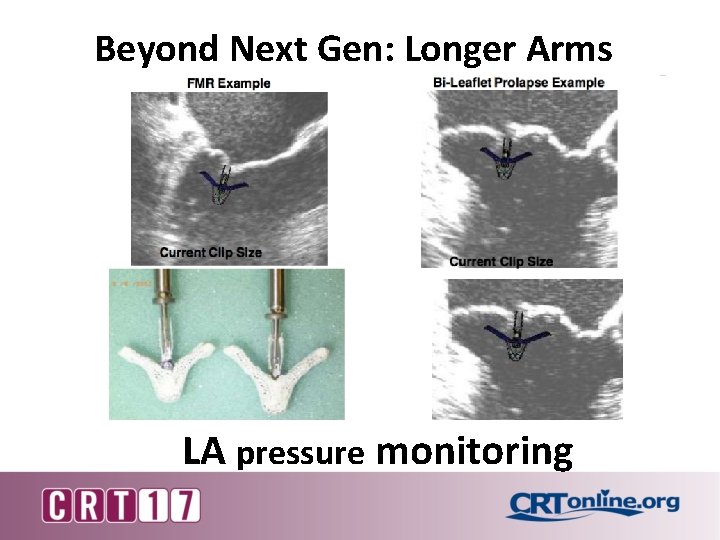 Beyond Next Gen: Longer Arms LA pressure monitoring 