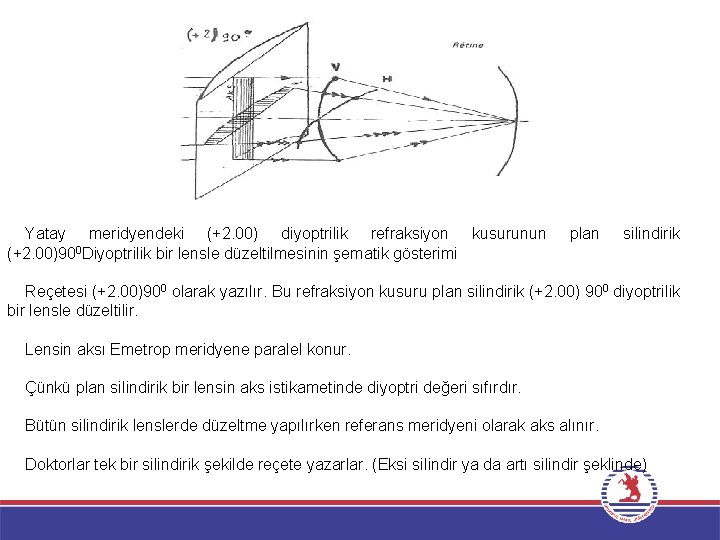 Yatay meridyendeki (+2. 00) diyoptrilik refraksiyon kusurunun (+2. 00)900 Diyoptrilik bir lensle düzeltilmesinin şematik