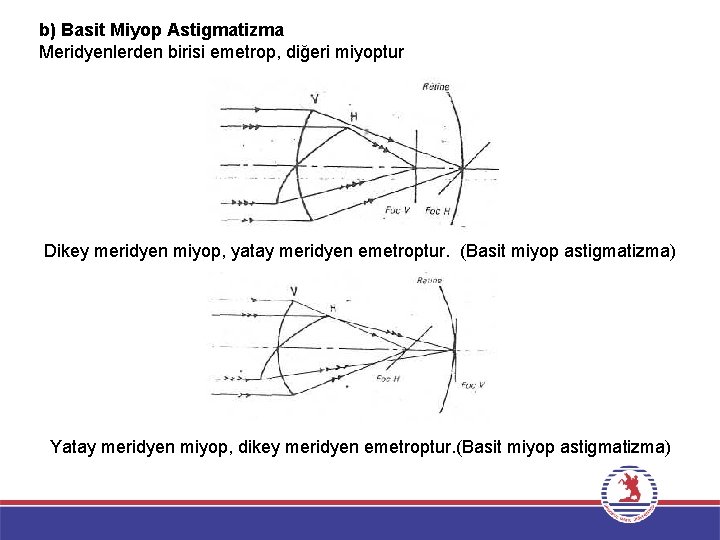 b) Basit Miyop Astigmatizma Meridyenlerden birisi emetrop, diğeri miyoptur Dikey meridyen miyop, yatay meridyen