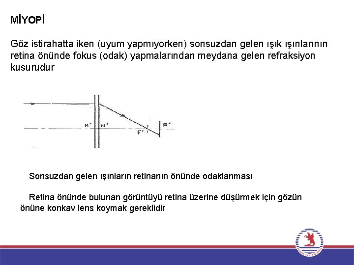 MİYOPİ Göz istirahatta iken (uyum yapmıyorken) sonsuzdan gelen ışık ışınlarının retina önünde fokus (odak)