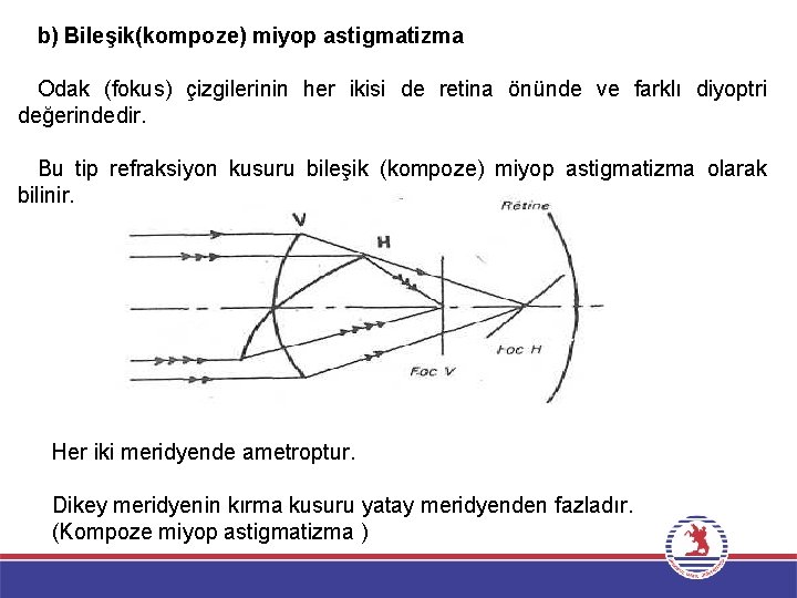 b) Bileşik(kompoze) miyop astigmatizma Odak (fokus) çizgilerinin her ikisi de retina önünde ve farklı