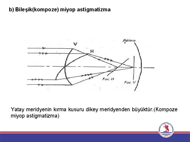 b) Bileşik(kompoze) miyop astigmatizma Yatay meridyenin kırma kusuru dikey meridyenden büyüktür. (Kompoze miyop astigmatizma)