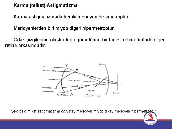 Karma (mikst) Astigmatizma Karma astigmatizmada her iki meridyen de ametroptur. Meridyenlerden biri miyop diğeri