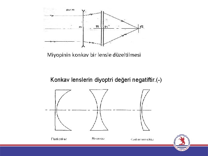 Miyopinin konkav bir lensle düzeltilmesi Konkav lenslerin diyoptri değeri negatiftir. ( ) 