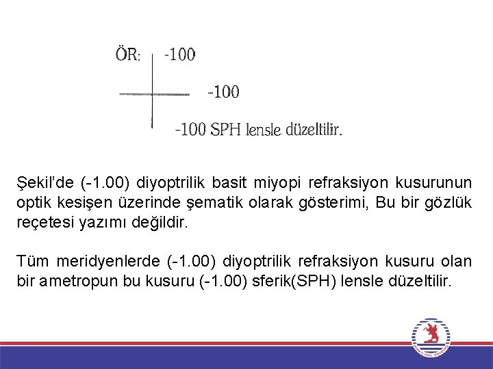 Şekil’de ( 1. 00) diyoptrilik basit miyopi refraksiyon kusurunun optik kesişen üzerinde şematik olarak