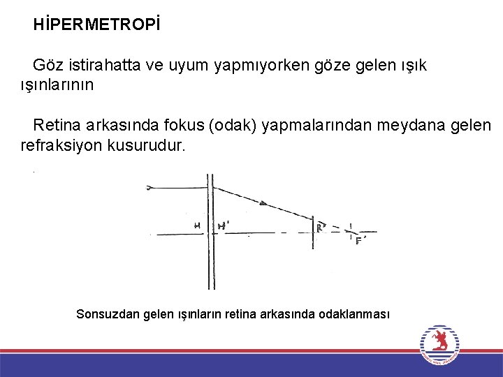 HİPERMETROPİ Göz istirahatta ve uyum yapmıyorken göze gelen ışık ışınlarının Retina arkasında fokus (odak)