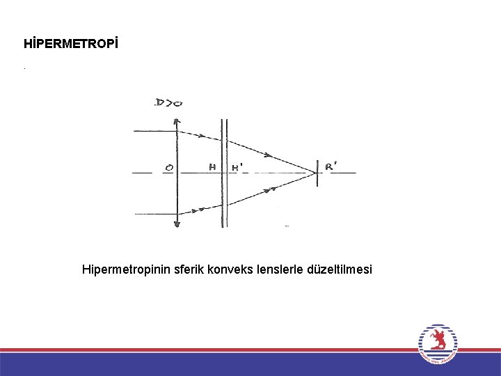 HİPERMETROPİ. Hipermetropinin sferik konveks lenslerle düzeltilmesi 