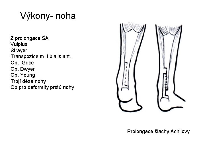 Výkony- noha Z prolongace ŠA Vulpius Strayer Transpozice m. tibialis ant. Op. Grice Op.