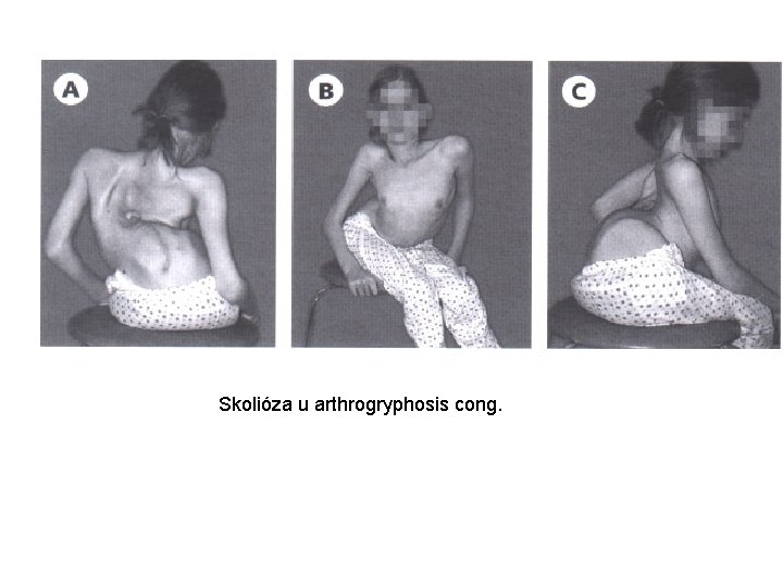 Skolióza u arthrogryphosis cong. 