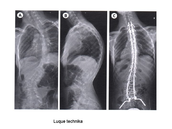Luque technika 