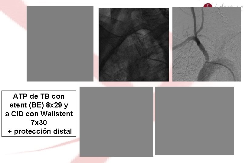 ATP de TB con stent (BE) 8 x 29 y a CID con Wallstent