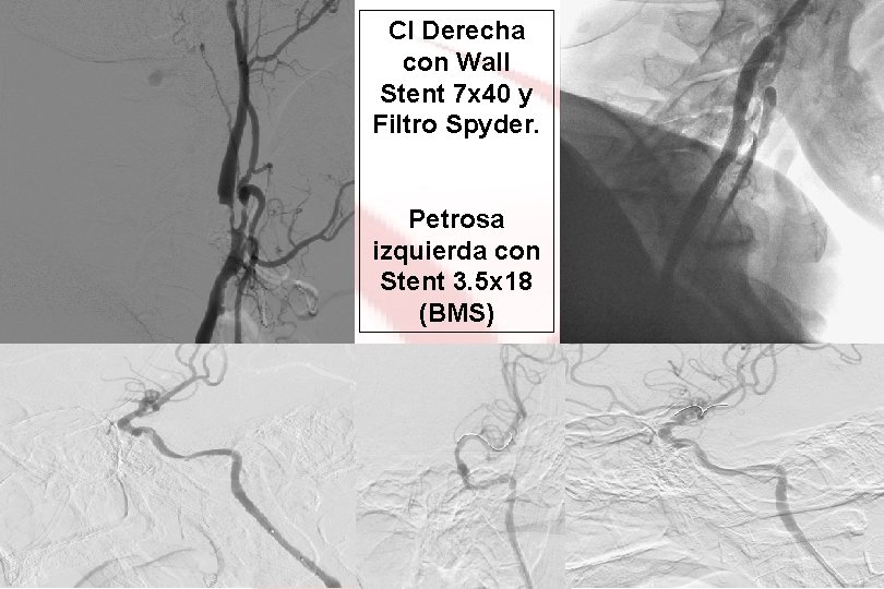 CI Derecha con Wall Stent 7 x 40 y Filtro Spyder. Petrosa izquierda con